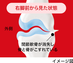進行期