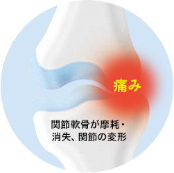 関節軟骨が摩耗・消失、関節の変形